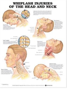 Whiplash Injuries of the Head and Neck Anatomical Chart