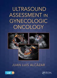 Ultrasound Assessment in Gynecologic Oncology Ultrasound Assessment in Gynecologic Oncology