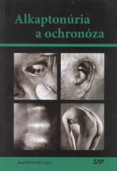 Alkaptonúria a ochronóza Alkaptonúria a ochronóza