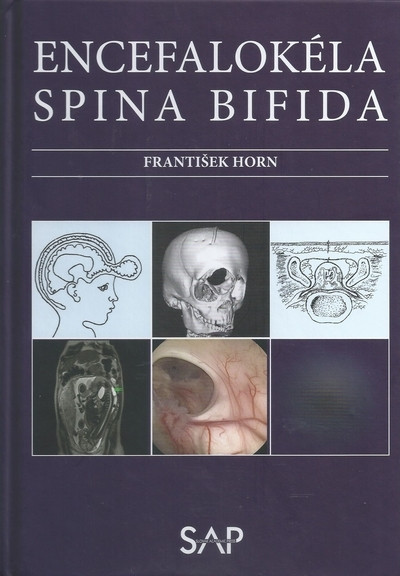 Encefalokéla spina bifida
