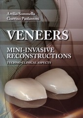 Veneers - Mini-invasive Reconstructions Veneers - Mini-invasive Reconstructions