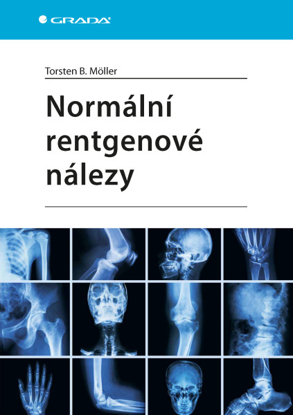 Normální rentgenové nálezy Normální rentgenové nálezy