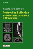 Roztroušená skleróza a onemocnění bílé hmoty v MR zobrazení Roztroušená skleróza a onemocnění bílé hmoty v MR zobrazení