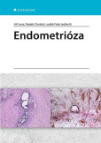 Endometrióza Endometrióza