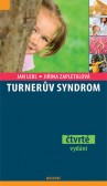 Turnerův syndrom Turnerův syndrom