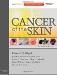 Cancer of the Skin Cancer of the Skin